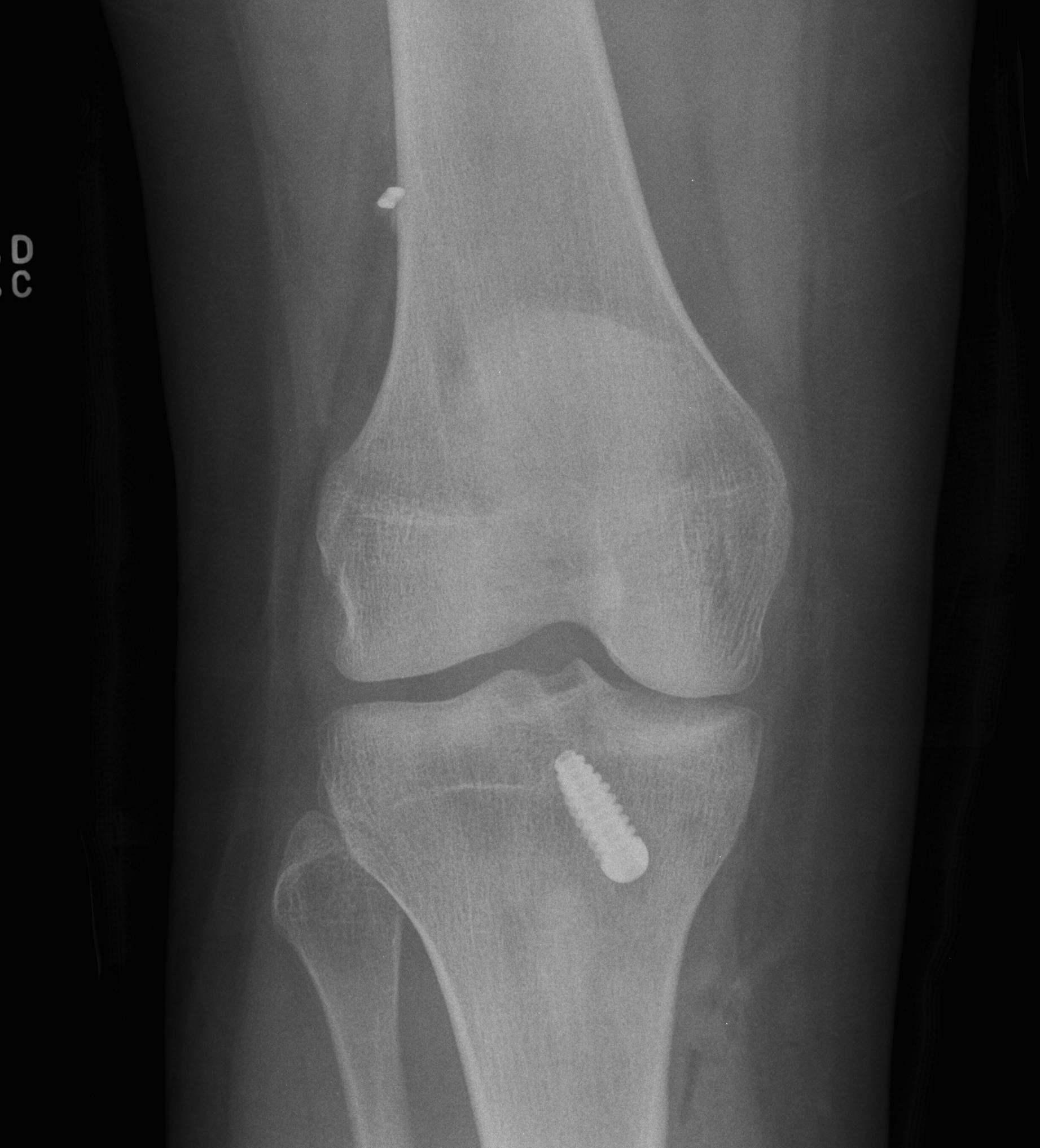 ACL Reconstruction Long Femoral Tunnel